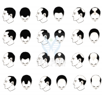 【贝斯特全球奢华基因检测】过早<font color='red'>脱发</font>、掉发太多怎么办？你的方法可能是错的！
